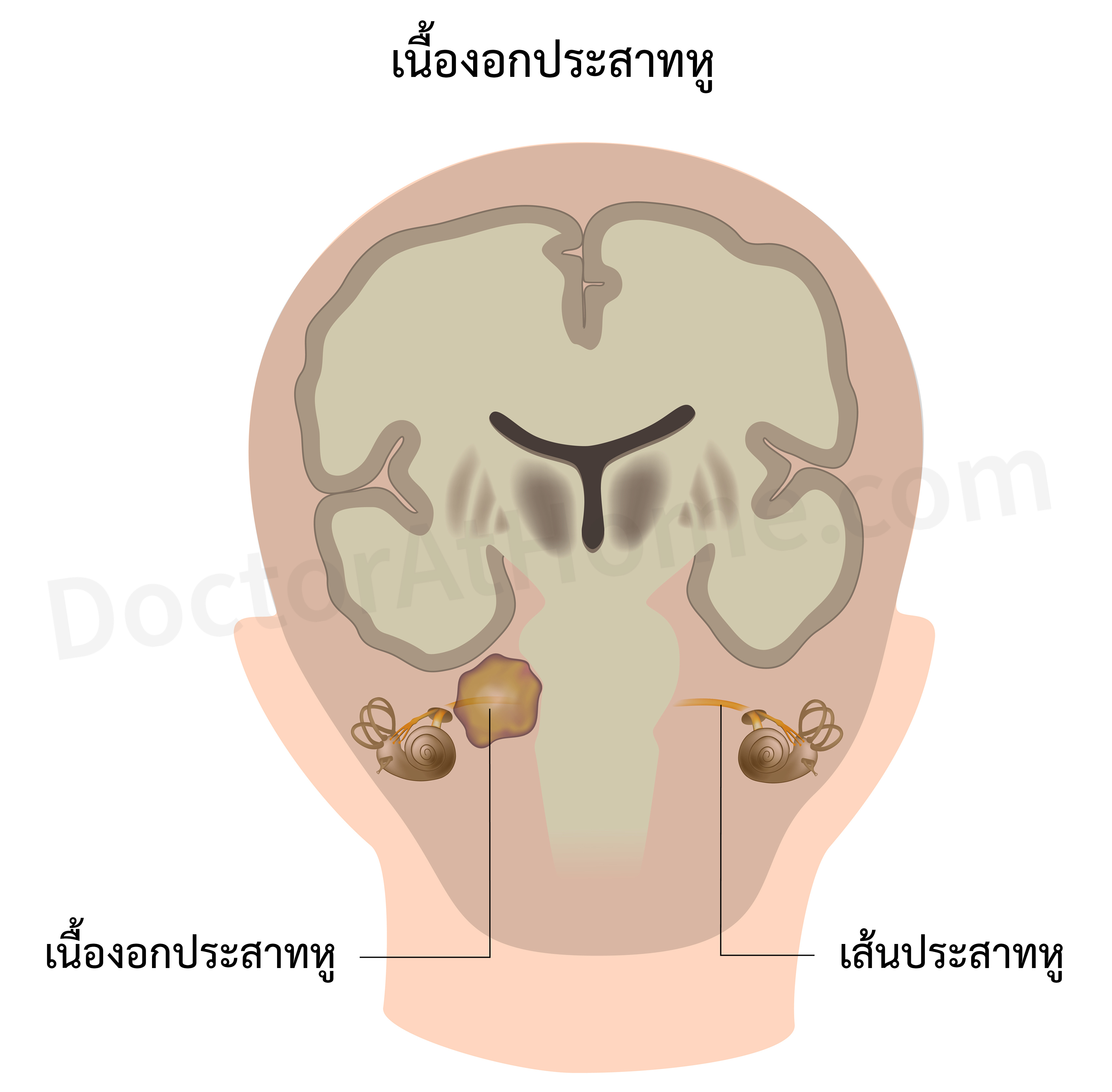 เนื้องอกประสาทหู